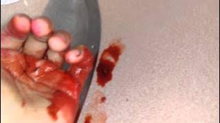 Tangan kena pisau