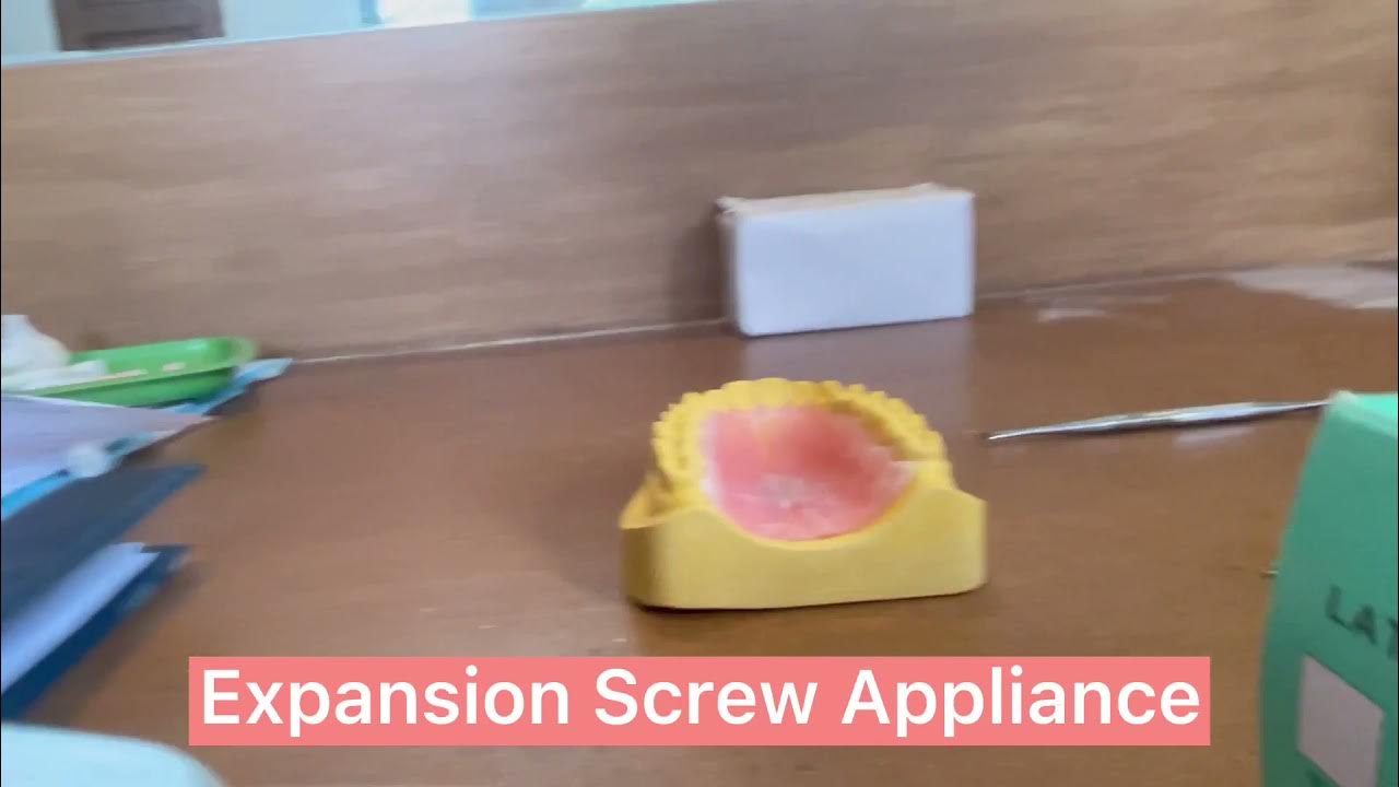 Expansion Screw Appliance YouTube