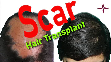 SCAR Hair Transplant: How to produce good growth in scar tissue and cover the area aesthetically!