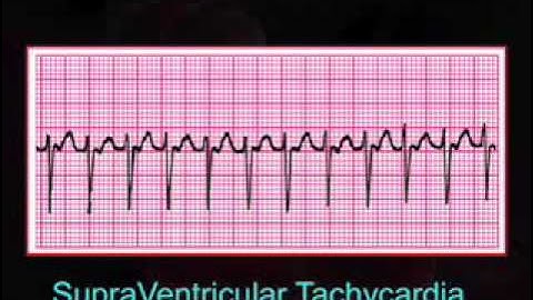 Introduction to EKG Rhythm Interpretation (Part 3)