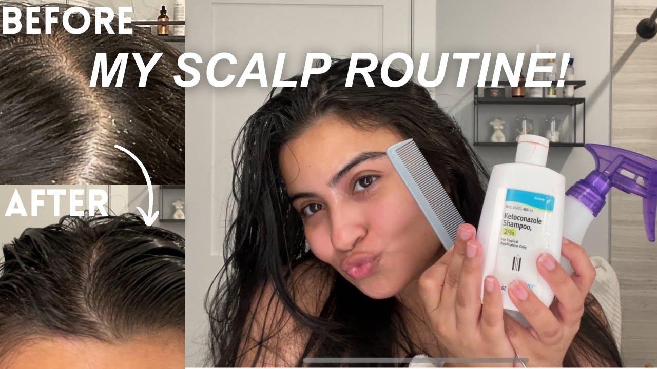 Seborrheic Dermatitis *scalp routine* YouTube