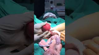 Cesarean Section baby delivery. #gynaecologists #3rdyear #mbbs #mbbsmotivation. #viralvideo