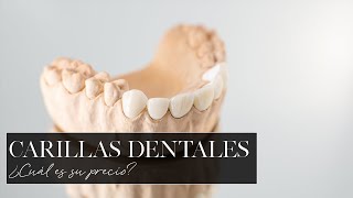 Carillas dentales: ¿Cuál es su precio?