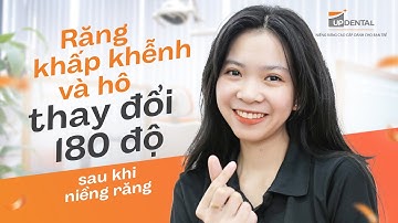 Răng khấp khểnh và hô thay đổi 180 độ sau khi niềng răng