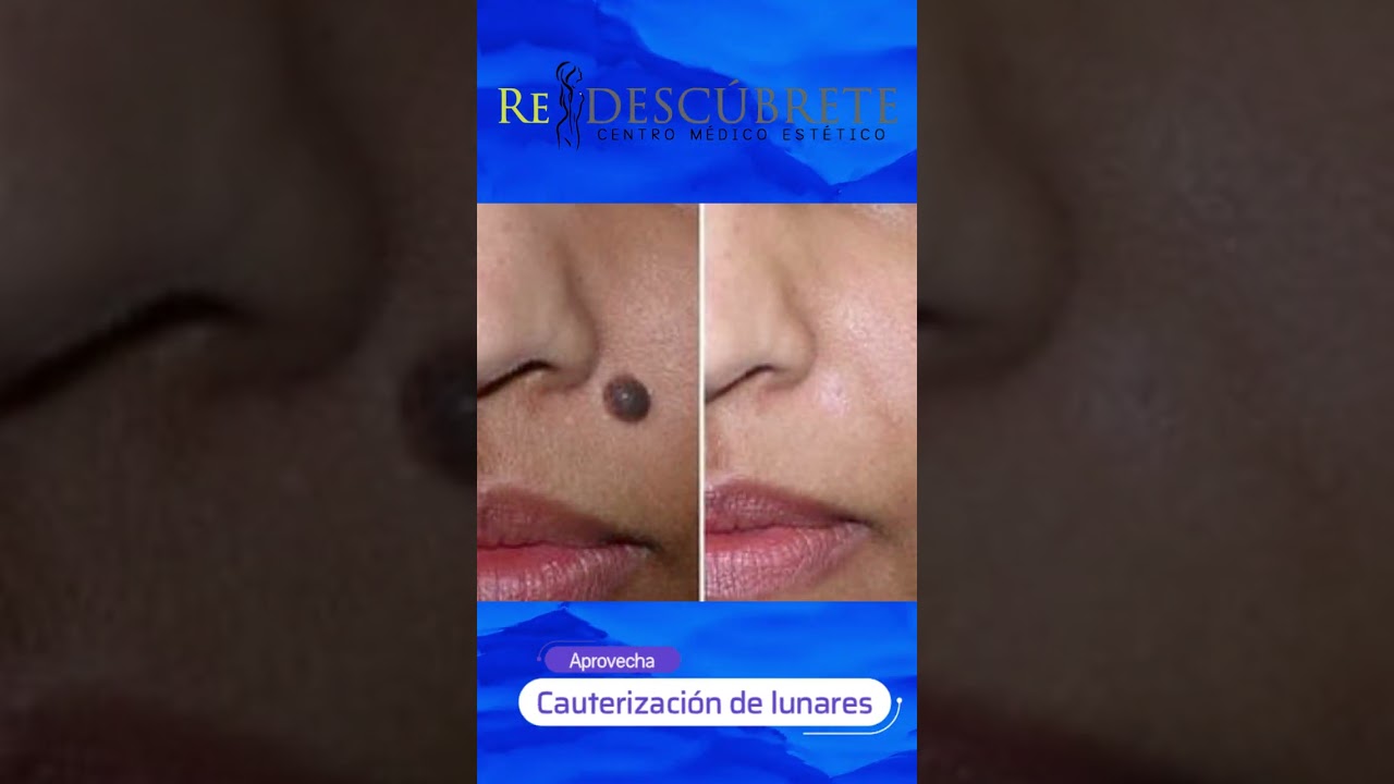 Cauterización de lunares 😀