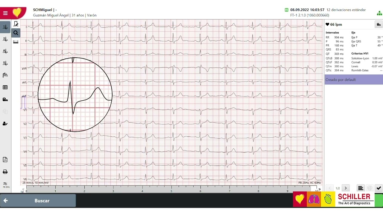 Qué es el SEMA de SCHILLER y como funciona 