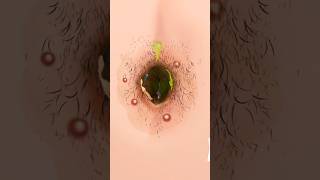 Extreme Belly On Cleaning Asmr Navel Dirt & Worm Removal Oddly Satisfying Animation