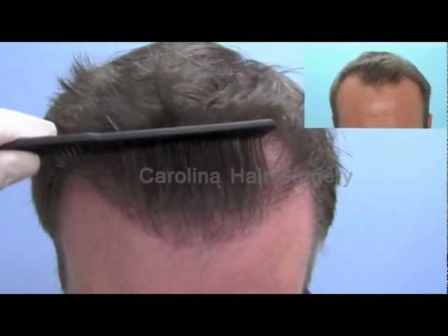 Close Up Hair Transplant Hairlines Achieved with Neograft FUE | Charlotte, Columbia & Charleston