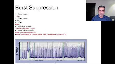 Amplitude integrated EEG aEEG made easy