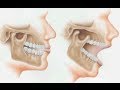Orthotropic treatment of jaw jointtemporomandibular disorder tmd by dr mike mew