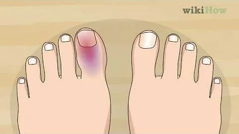How to Know if Your Toe Is Broken