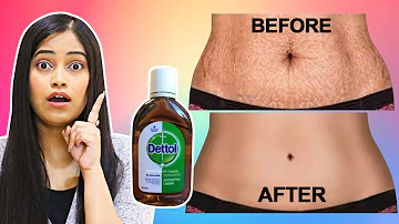 😮ज़िदी Stretch Marks Scars ko 2 Days Me Hataye Permanently?REMOVE STRETCH MARKS NATURALLY #BeNatural