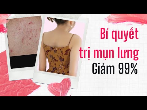 Cách trị MỤN LƯNG hiệu quả tại nhà