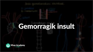 Gemorragik insult | Insult | Tibbiyot