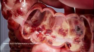 Ulcerative Colitis Medications | 3D Medical Animation | Pixeldust Studios