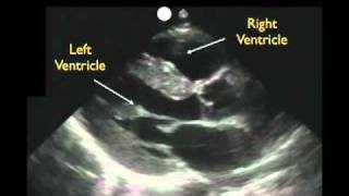 Cardiac Ultrasound - Parasternal Long Axis - Part 1 - Sonosite, Inc.