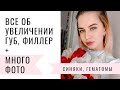 ВСЕ ОБ УВЕЛИЧЕНИИ ГУБ, ВРЕДНО ЛИ? ФОТООТЧЕТ ВОССТАНОВЛЕНИЯ ПО ДНЯМ!