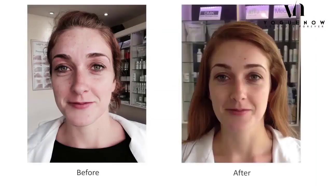 by Dermatologists and Estheticians LED Light Therapy