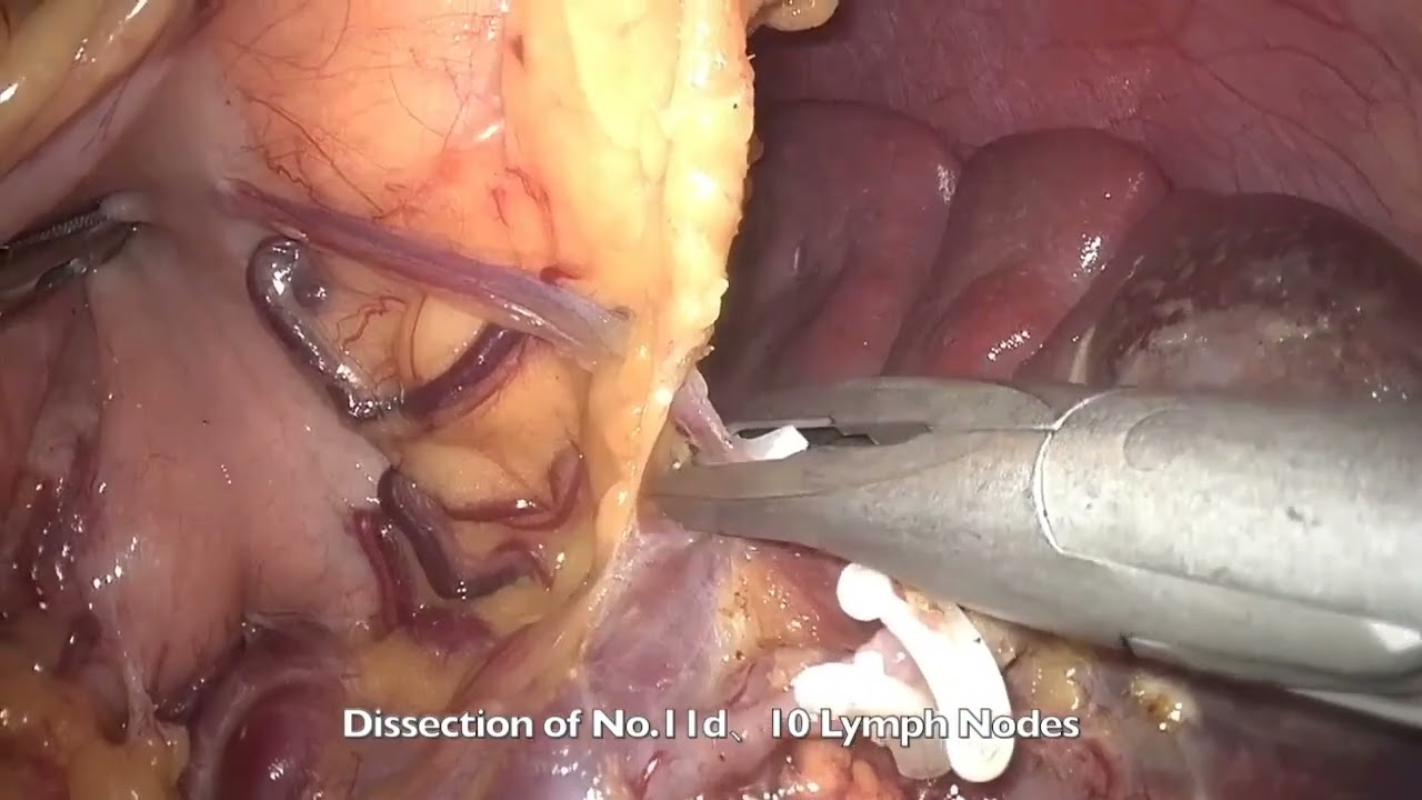 Totally Laparoscopic Total Gastrectomy+ Roux-en-Y anastomosis (Overlap) 全腔镜胃RY吻合