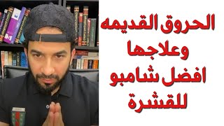 الحروق القديمه وعلاجها - افضل شامبو للقشرة - دكتور طلال