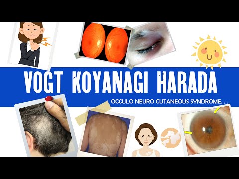 Video: Vogt-Koyanagi-Harada Liga: Retos Autoimuninės Ligos, Nukreiptos Prieš Melanocitų Antigenus, Apžvalga