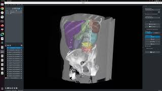 [Napari] CT organ segmentation with nnInteractive