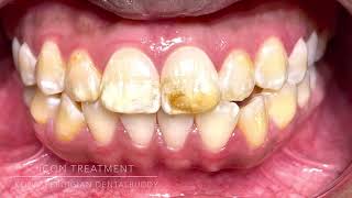 Icon treatment (Fluorosis)