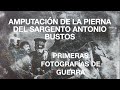 Las PRIMERAS FOTOS DE GUERRA. Amputación de la pierna del Sargento Bustos.