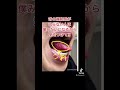 僕は舌癌ステージ4 #癌#舌癌 #看護師 #歯科医師 #aya世代