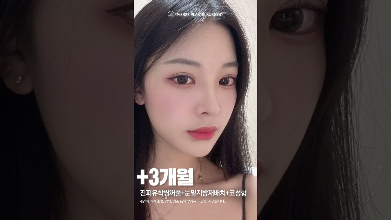 [Вивэрс гоо сайхны мэс заслын эмнэлэг] Би хөөрхөн болохоор! Вивэрс #богино_бичлэг #дермисийн_уялдаатай_давхар_зовхи #хамар_мэс_засал