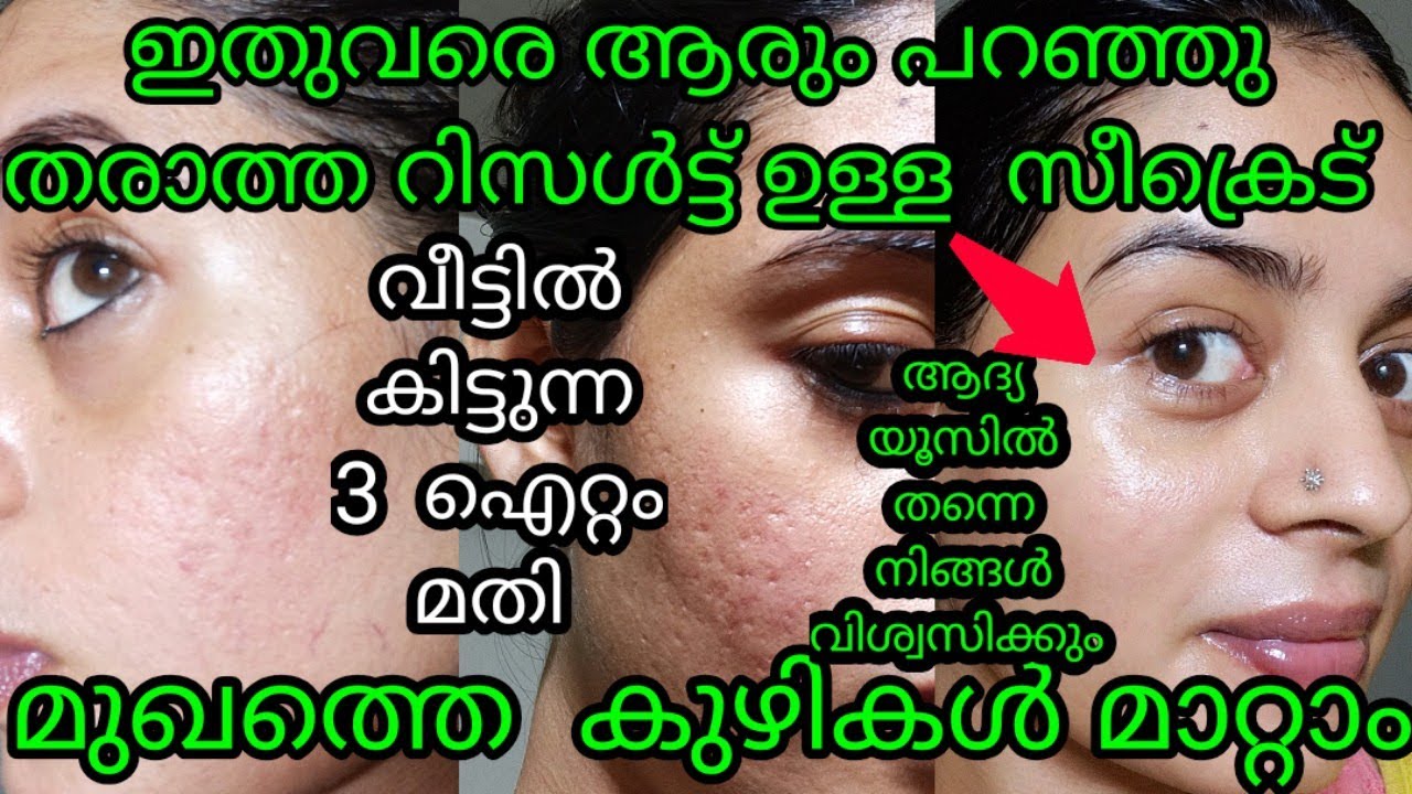 acne prone skin meaning in malayalam Vanessa Roberts