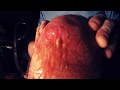 Puss Bacteria Drain From Septic Knee