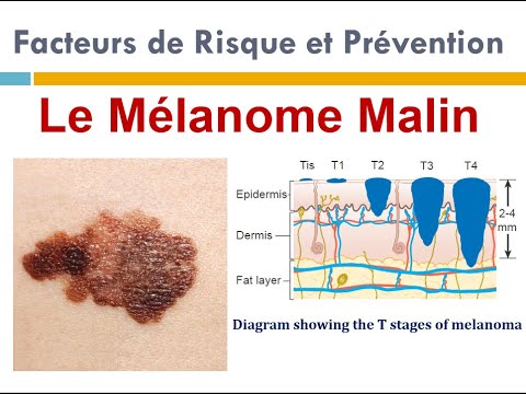 Vidéo: À quelle vitesse les mélanomes se développent-ils ?