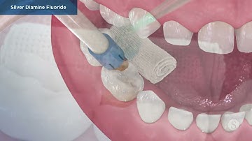 Silver Diamine Fluoride - Step By Step Demonstration