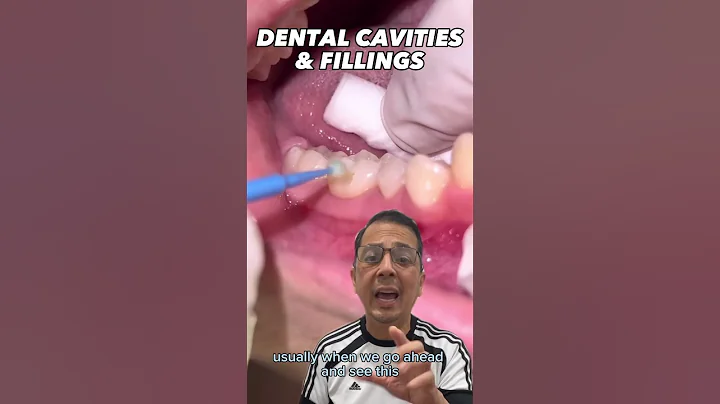 Composite Dental Filling on Common Cavity (Buccal) | In Office to Hands On Dental Training #shorts