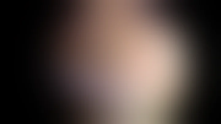 Single-Stage Arthroscopic Cartilage Repair With Injectable Scaffold and BMAC