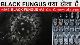 Black Fungus क्या है कैसे होता है Symptoms, Prevention and treatment, Full Detail in Hindi