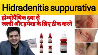 Hidradenitis suppurativa | Treatment of Hidradenitis suppurativa | Homeopathic medicine | Cause |