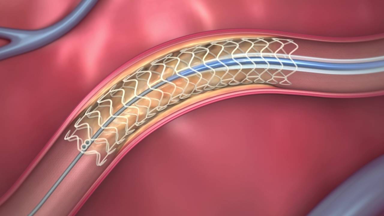 Fda Approved Dissolving Heart Stent How It Works Youtube