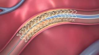 FDAApproved Dissolving Heart Stent | How It Works