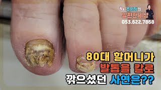 80대 고객님 발톱이 이렇게?!  #발 #발톱 #내성발톱 #무좀발톱 #대구내성발톱