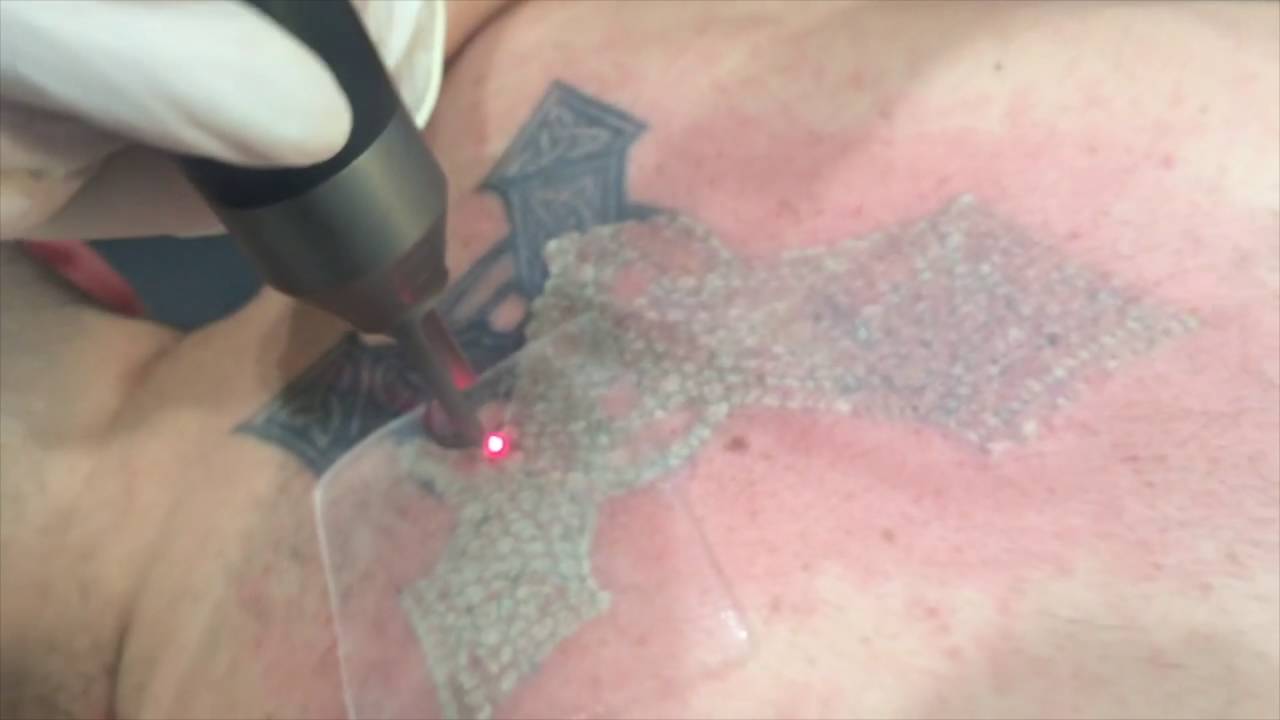 laser light specialists tattoo removal in san francisco ca laser light specialists tattoo removal in san francisco ca