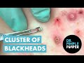 50 minutes of blackheads clusters of blackheads with dr pimple popper
