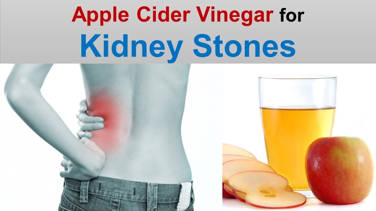 Apple cider vinegar for kidney stones remove kidney stones with acv