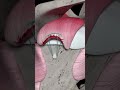 Rotator cuff repair animation