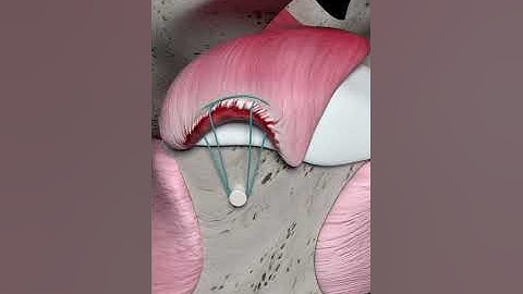 Rotator Cuff Repair (Animation)