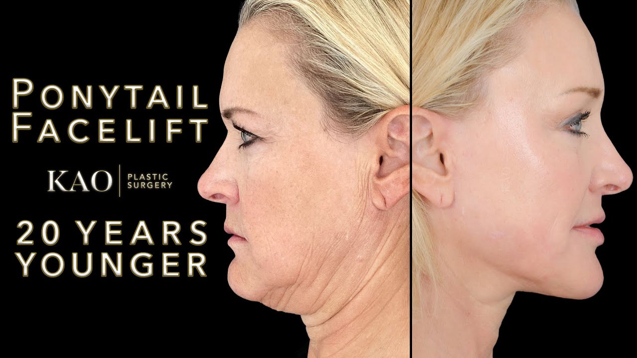20 Years Younger with Plastic Surgery? Dr. Kao Ponytail Facelift™ Before And After YouTube
