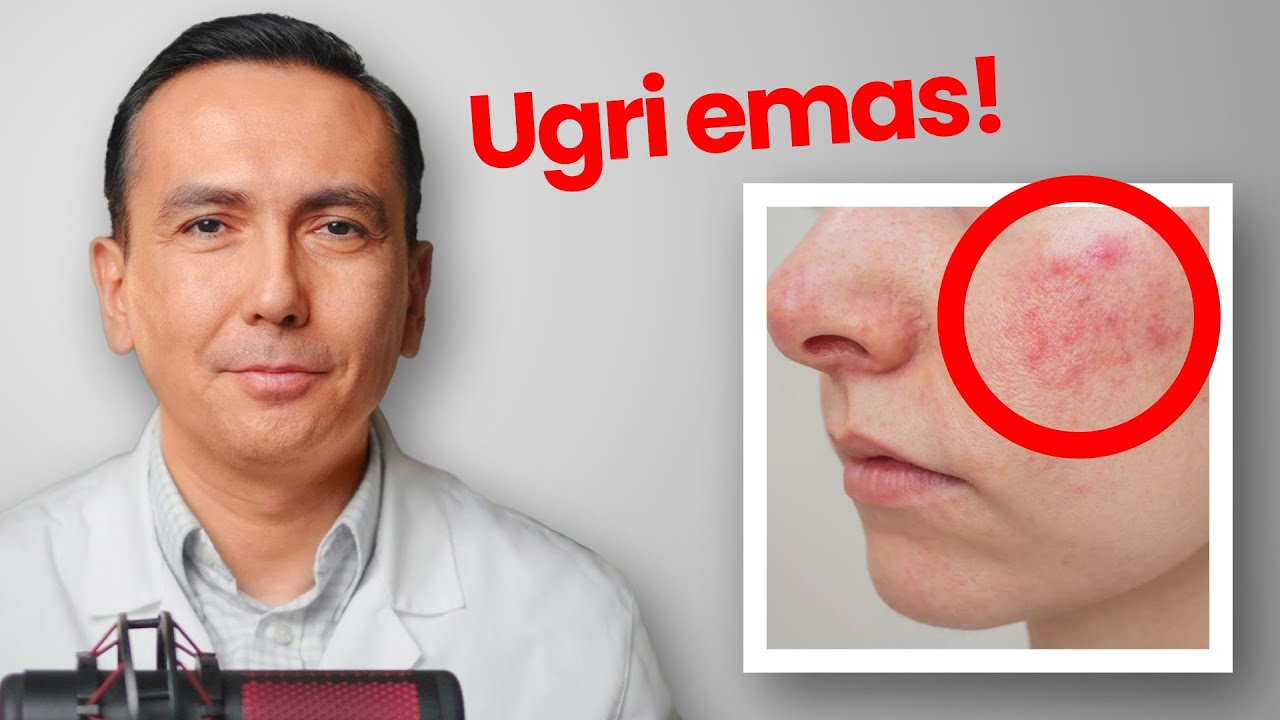 Rozatsea Kasalligi Qanday Davolanadi?