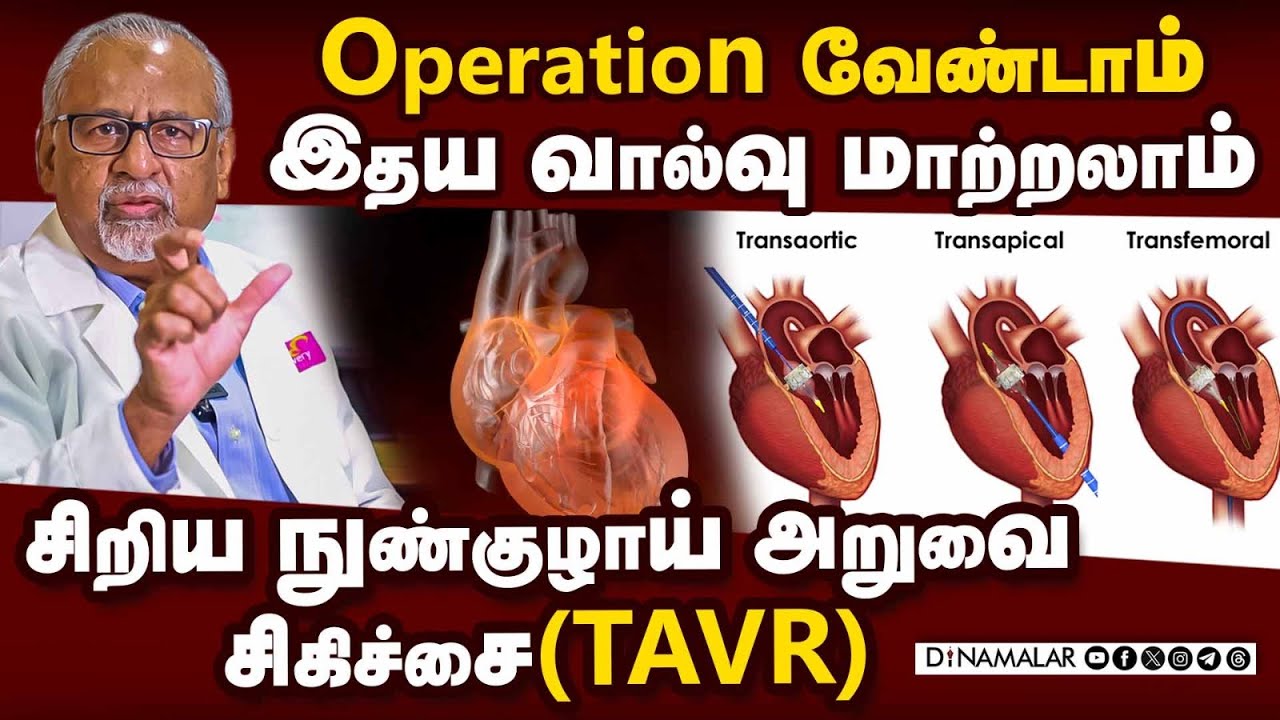 Operation வேண்டாம் இதய வால்வு மாற்றலாம் | சிறிய நுண்குழாய் அறுவை சிகிச்சை | TAVR | Kauvery Hospital