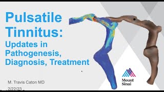 Pulsatile Tinnitus: Updates in Pathogenesis, Diagnosis, Treatment, Travis Caton, MD 02.22.2023